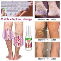 Varicose Veins Treatment Spray